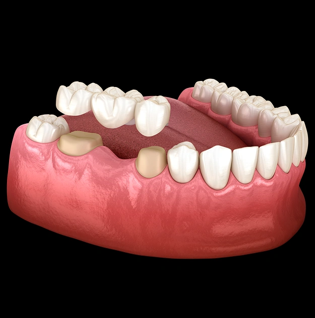 Dental Bridges