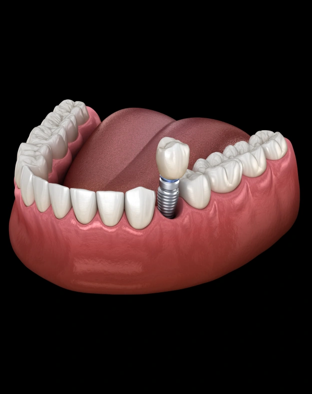 Dental Implants