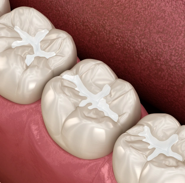 Dental Sealants