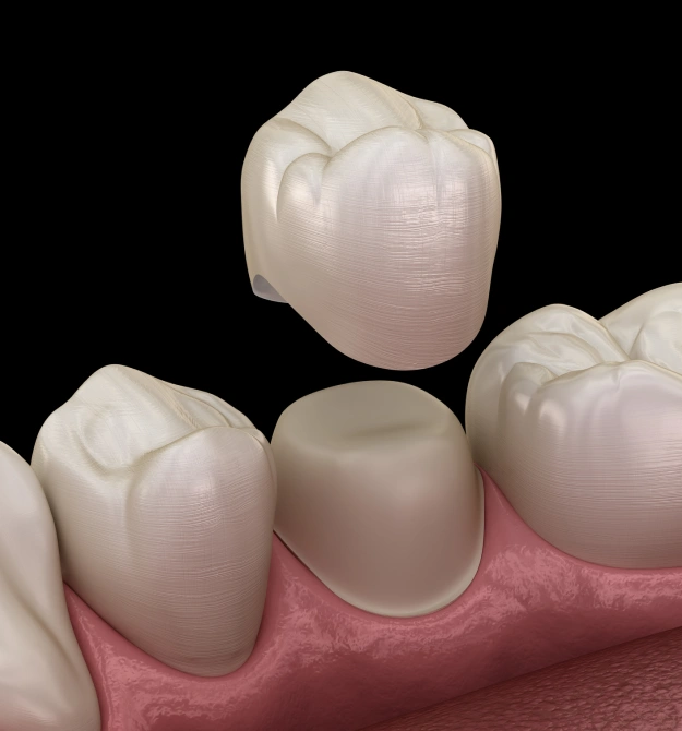 Same Day Crowns