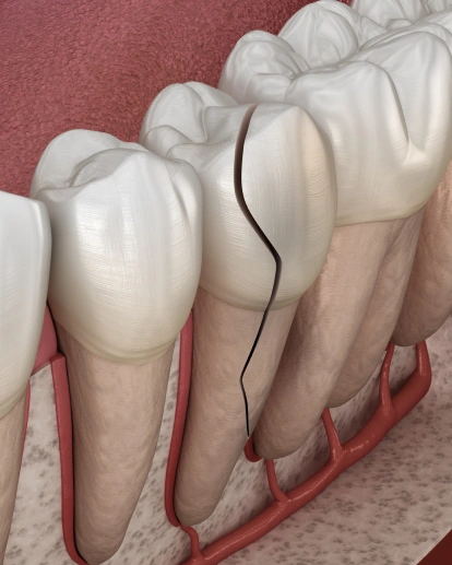 Cracked or fractured teeth