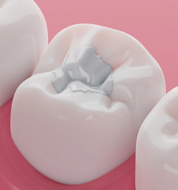 Dental Fillings