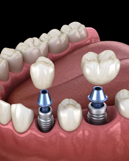 They protect neighboring teeth