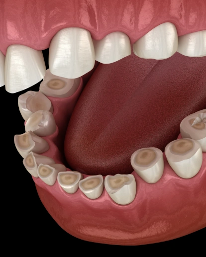 No Significant Bite Issues or Severe Bruxism