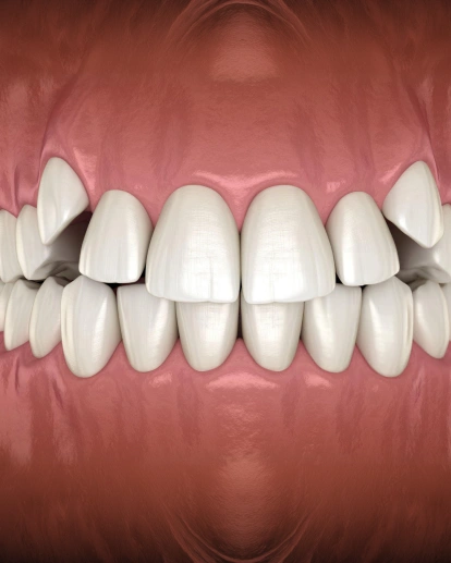 Crossbite