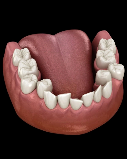 Crowded teeth