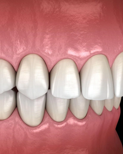 Overbite