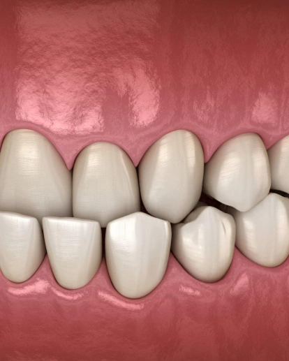Underbite