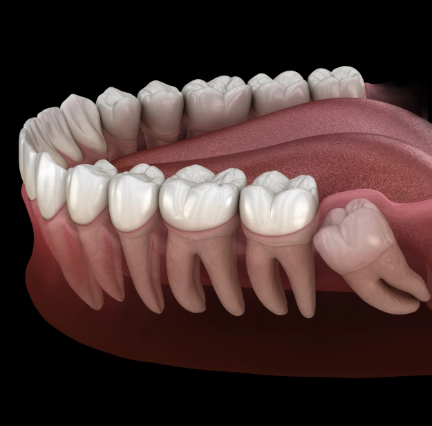 Wisdom Teeth Removal